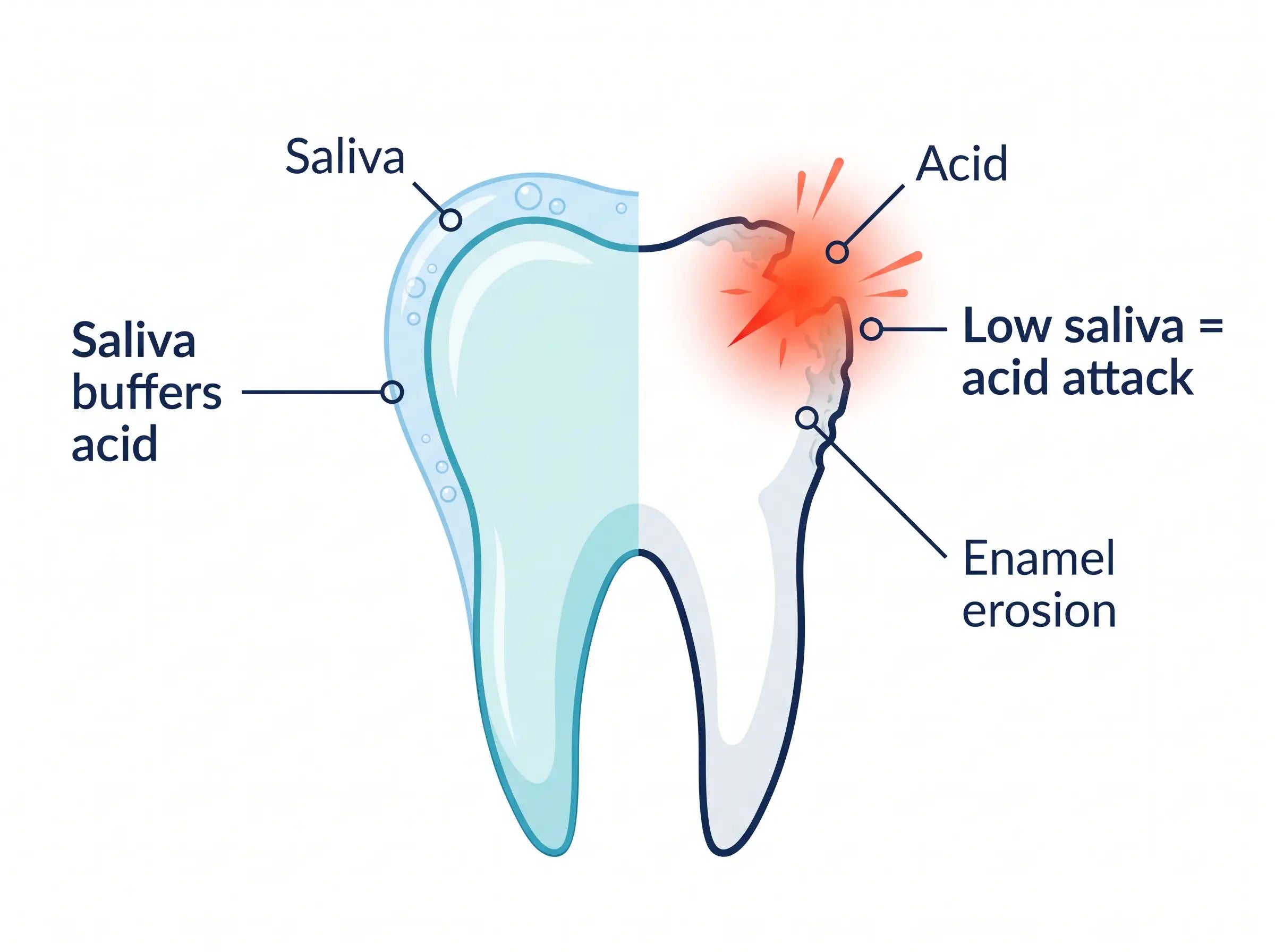 Diagram: saliva buffers acid; when saliva is low, acid attacks the enamel