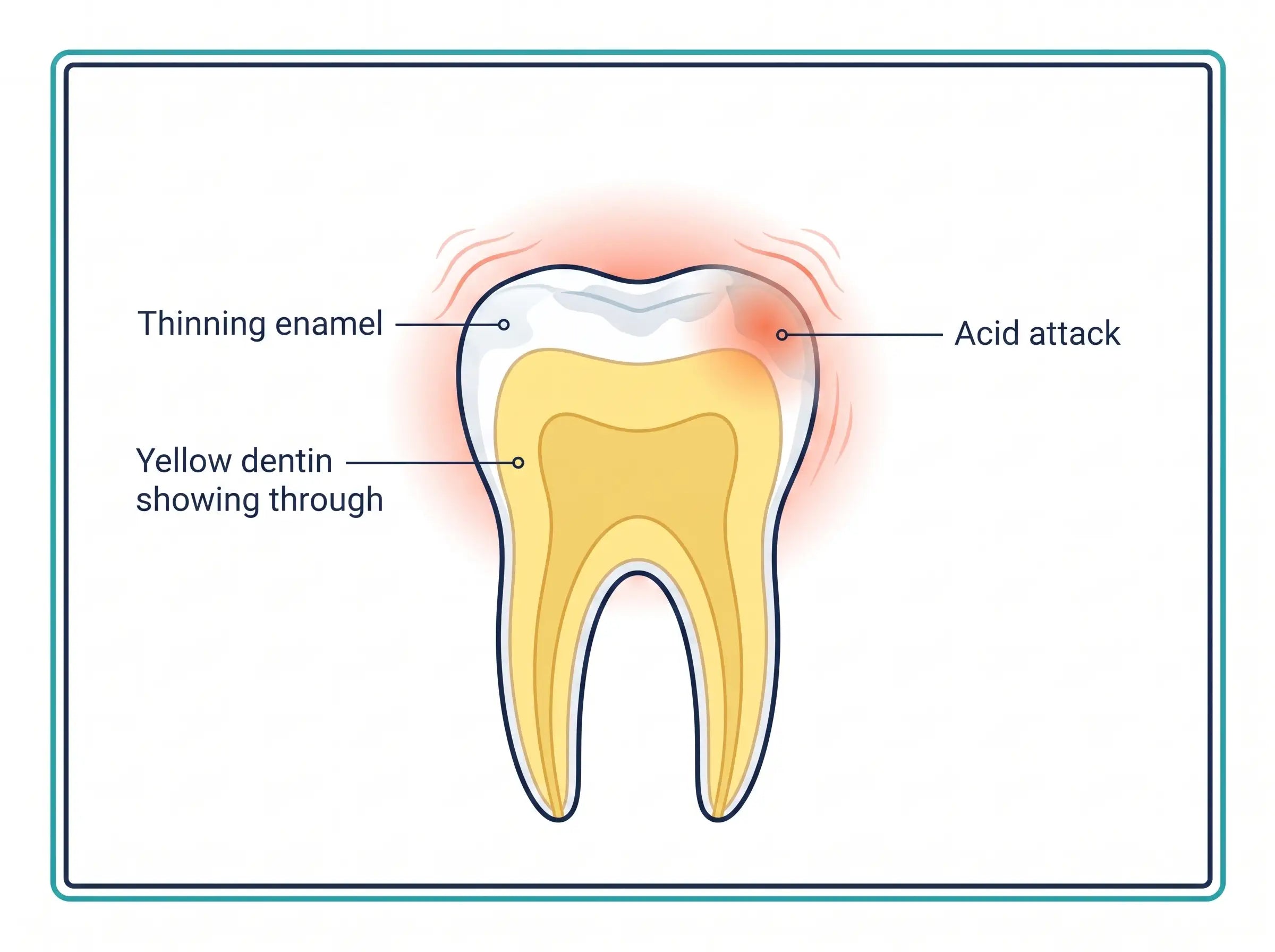 Labeled diagram showing the white enamel outer layer and the yellow dentin inner layer of a tooth